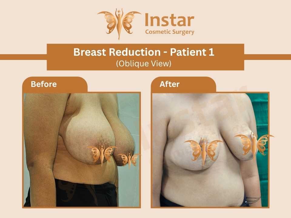 Breast Implant on Table-2 (2)